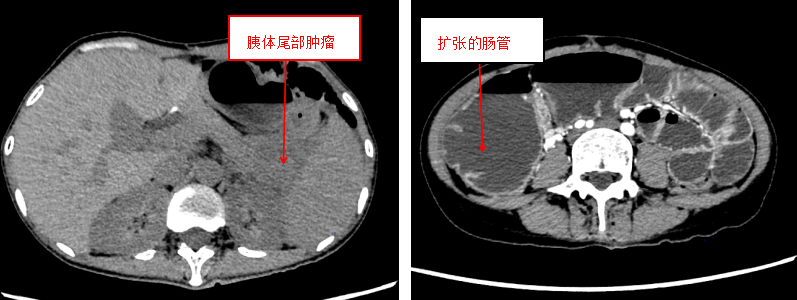 阳光融和医院再次完成四脏器联合切除，为 51 岁危重患者重燃生命之火