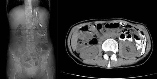 阳光融和医院再次完成四脏器联合切除，为 51 岁危重患者重燃生命之火