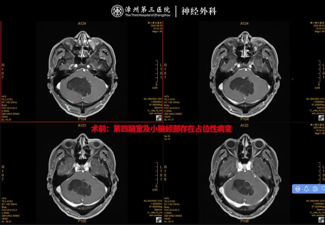 震惊！53 岁大叔头晕不当回事，颅内竟藏着罕见「珍珠」！