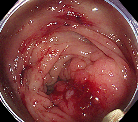 阳光融和医院再次完成四脏器联合切除，为 51 岁危重患者重燃生命之火