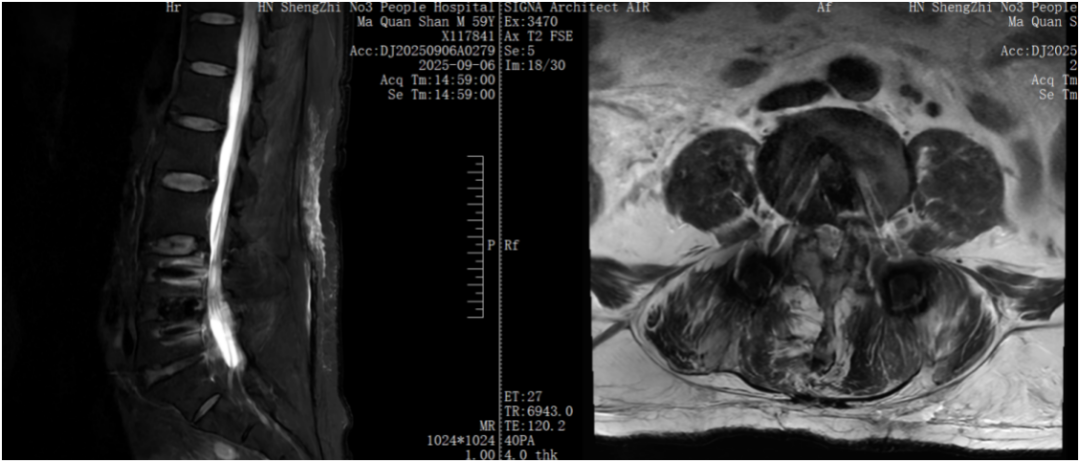九年透析患者怕再开刀？脊柱微创助力解决顽疾腰疼！