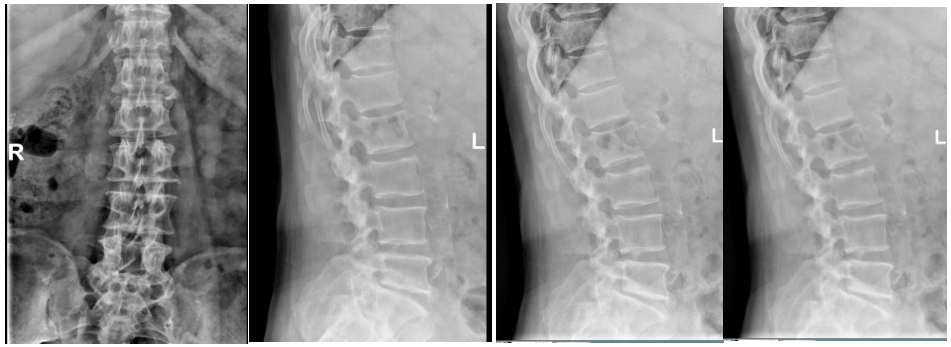 九年透析患者怕再开刀？脊柱微创助力解决顽疾腰疼！
