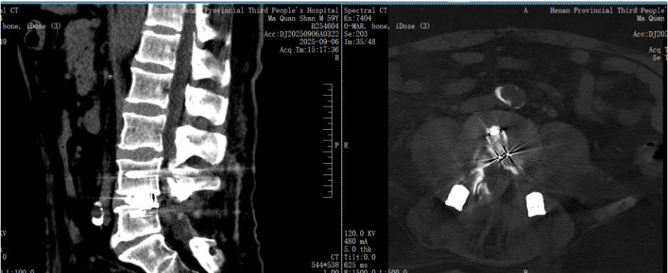 九年透析患者怕再开刀？脊柱微创助力解决顽疾腰疼！