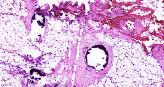 新突破|中大医院皮肤病临床诊疗成果再登 BMJ