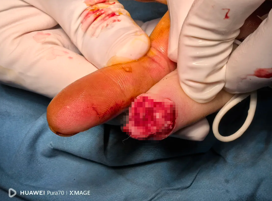 国庆我在岗丨当假期遭遇意外，他们成功续接断指