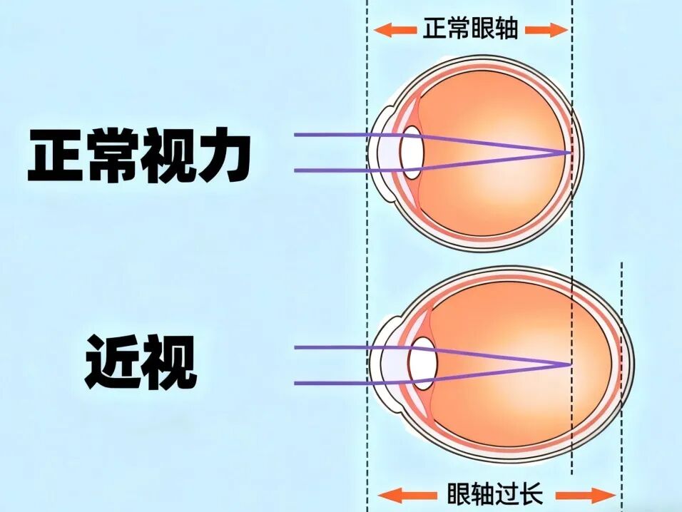 别只盯着度数！「眼轴长度」才是近视防控的黄金指标
