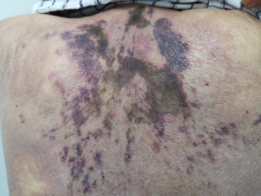 新突破|中大医院皮肤病临床诊疗成果再登 BMJ