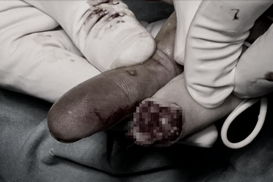 国庆我在岗丨当假期遭遇意外，他们成功续接断指