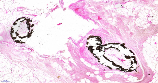 新突破|中大医院皮肤病临床诊疗成果再登 BMJ