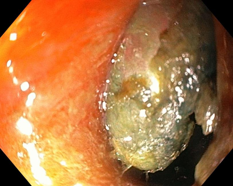 惊险！3 岁男孩误吞硬币卡喉，家长第一时间该做啥？