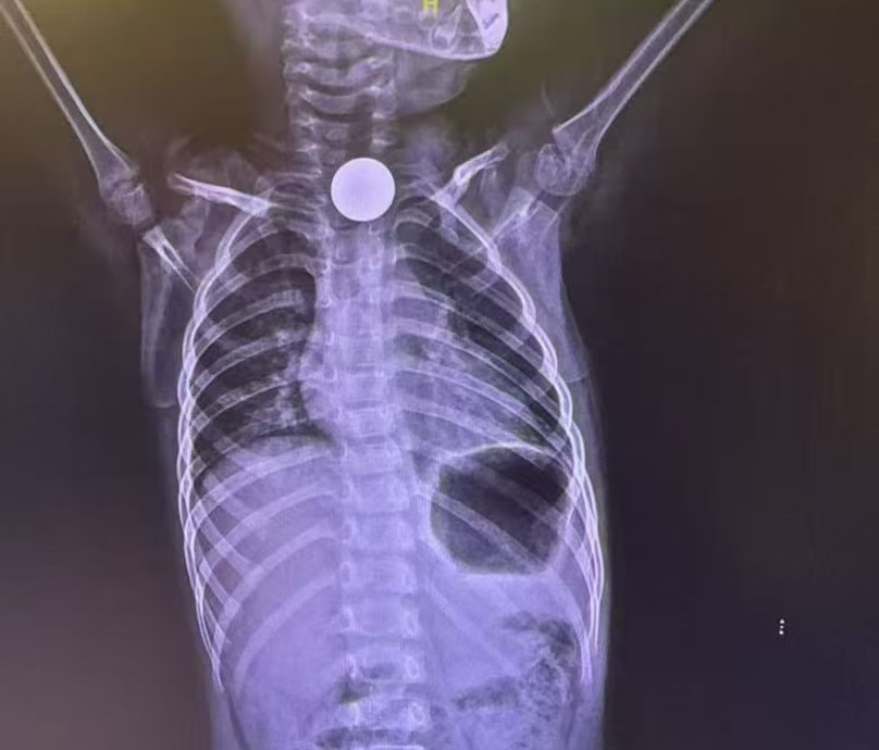惊险！3 岁男孩误吞硬币卡喉，家长第一时间该做啥？
