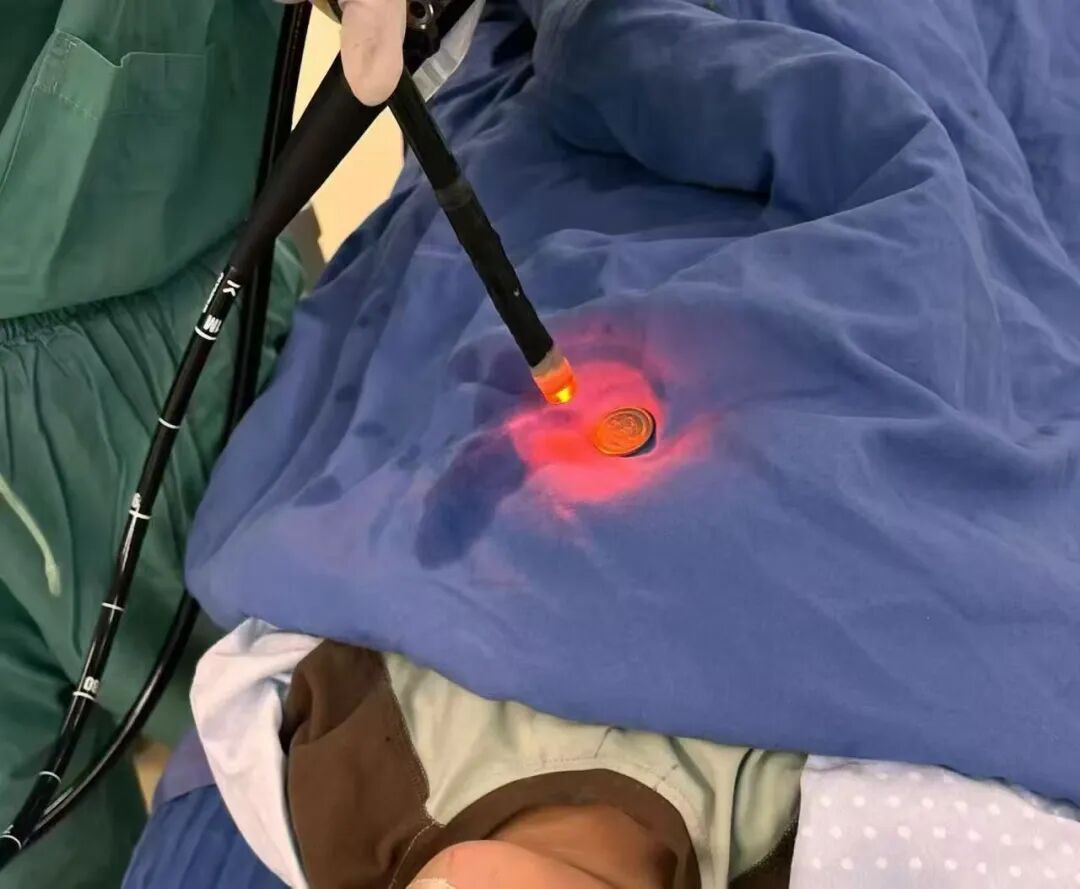 惊险！3 岁男孩误吞硬币卡喉，家长第一时间该做啥？