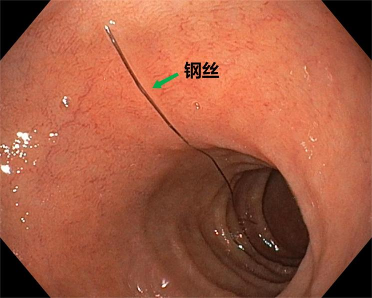惊险！3 岁男孩误吞硬币卡喉，家长第一时间该做啥？