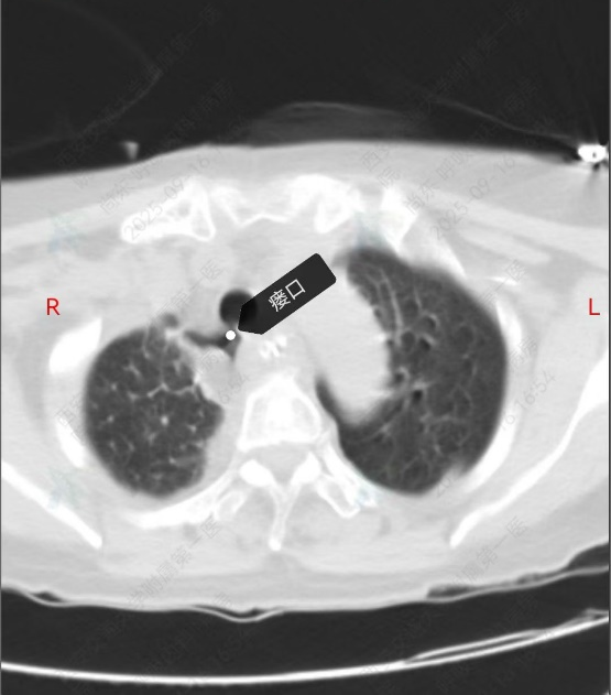 东院区成功开展首例「硬质气管镜下硅酮支架取出术」