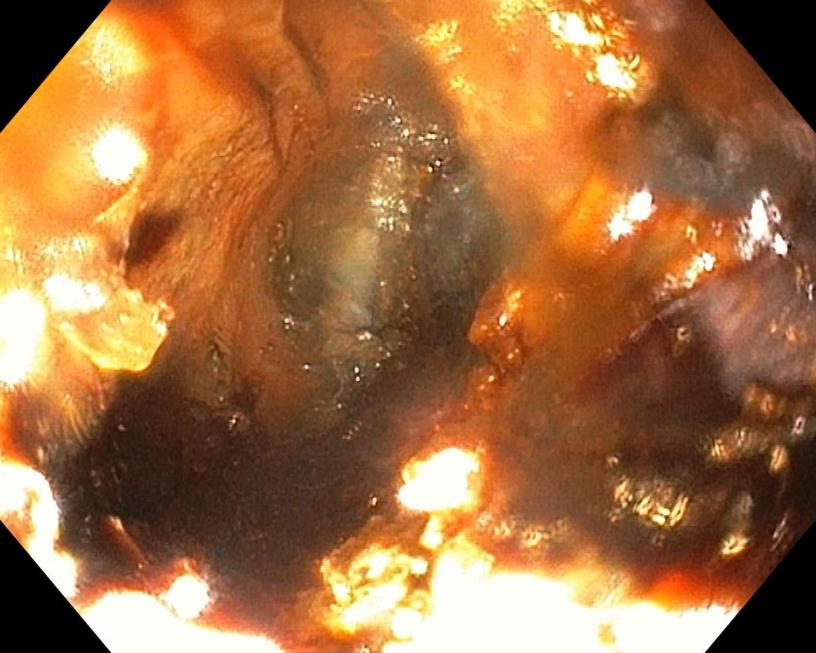 惊险！3 岁男孩误吞硬币卡喉，家长第一时间该做啥？