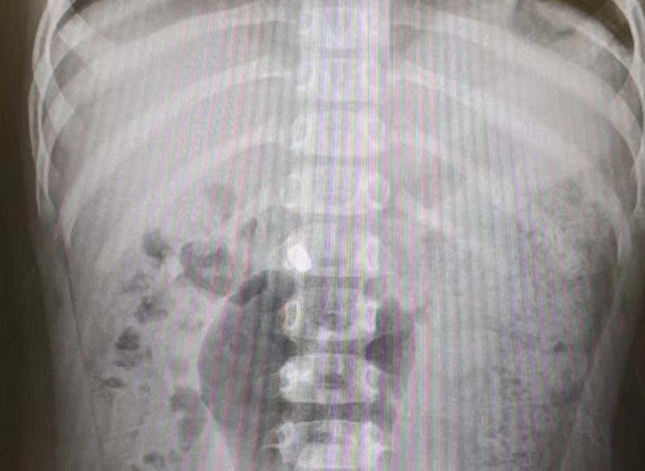 惊险！3 岁男孩误吞硬币卡喉，家长第一时间该做啥？