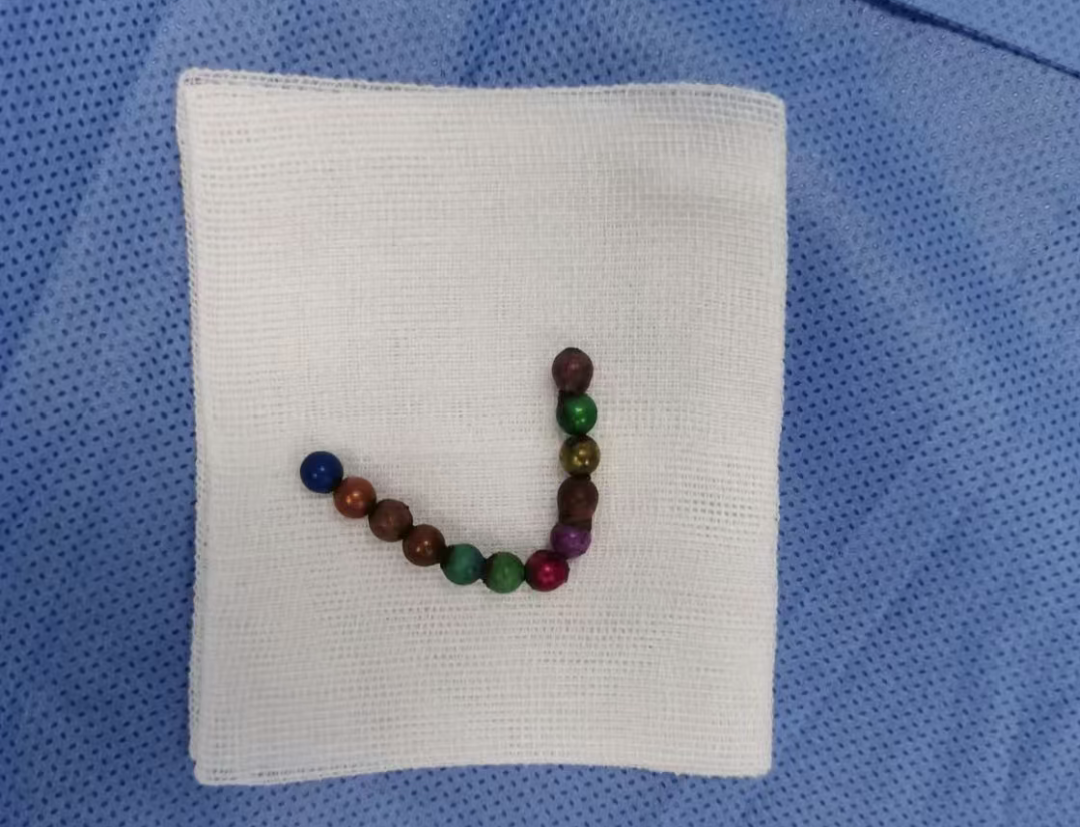 惊险！3 岁男孩误吞硬币卡喉，家长第一时间该做啥？