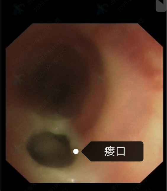 东院区成功开展首例「硬质气管镜下硅酮支架取出术」