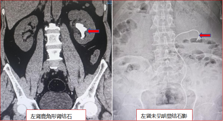 延安市中医医院泌尿外科联合麻醉手术科成功运用新术式为复杂性肾结石患者实施手术