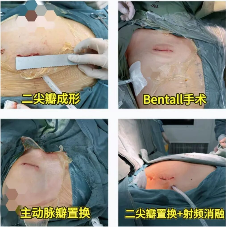 南昌大学二附院圆满举办第十五期微创心脏手术技术高级学习班