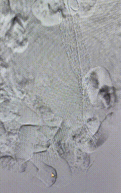 命悬「一线」！南京江北医院成功化解 94 岁老人体内支架脱落危机