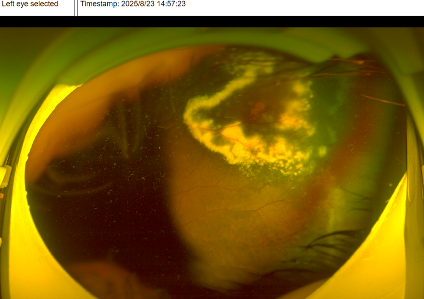 以为孩子只是近视，检查后却揪出「隐形眼病」！儿童眼底筛查别再忽视