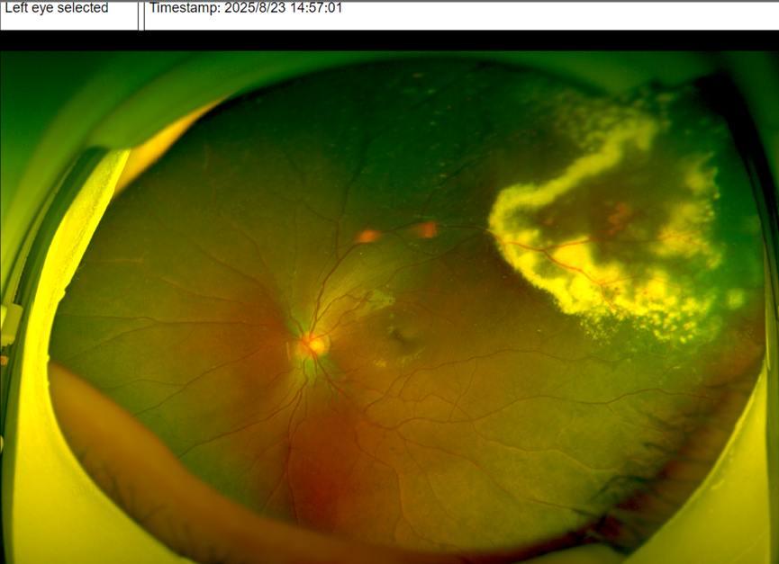 以为孩子只是近视，检查后却揪出「隐形眼病」！儿童眼底筛查别再忽视