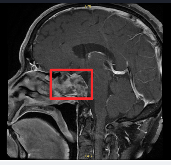 鼻内镜「精准拆弹」，中大医院专家微创切除颅底脊索瘤