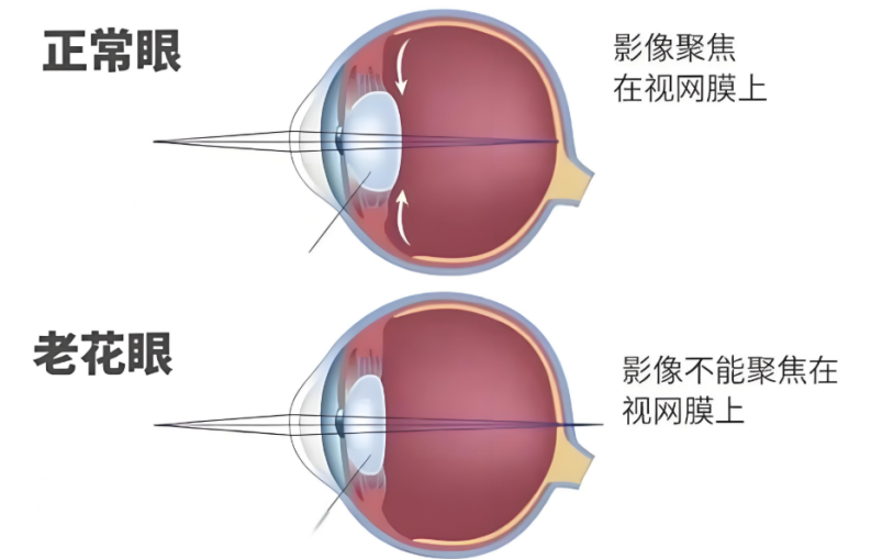知名主持人爆近视又老花！武汉普瑞眼科程旭康科普同时解决的方法