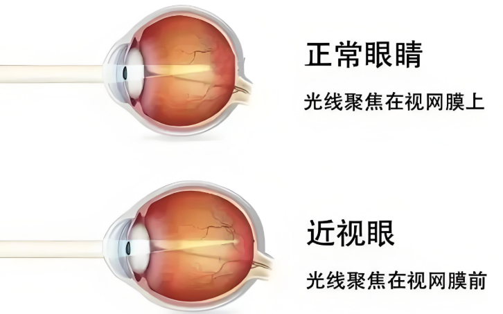 知名主持人爆近视又老花！武汉普瑞眼科程旭康科普同时解决的方法