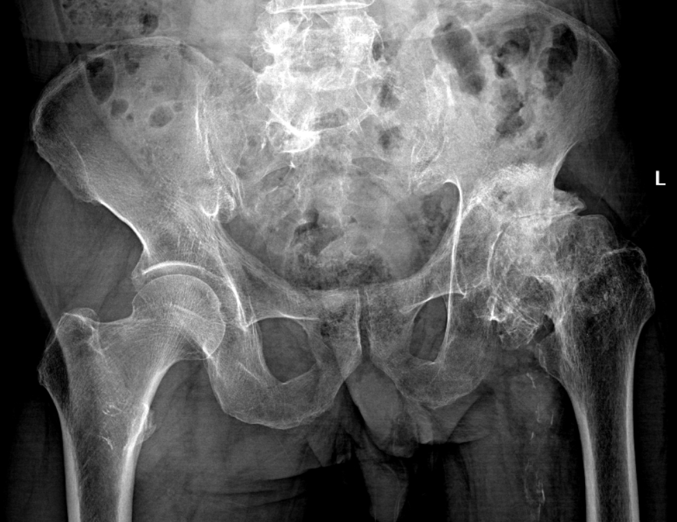 你的股骨头,可能比你先「醉倒」!