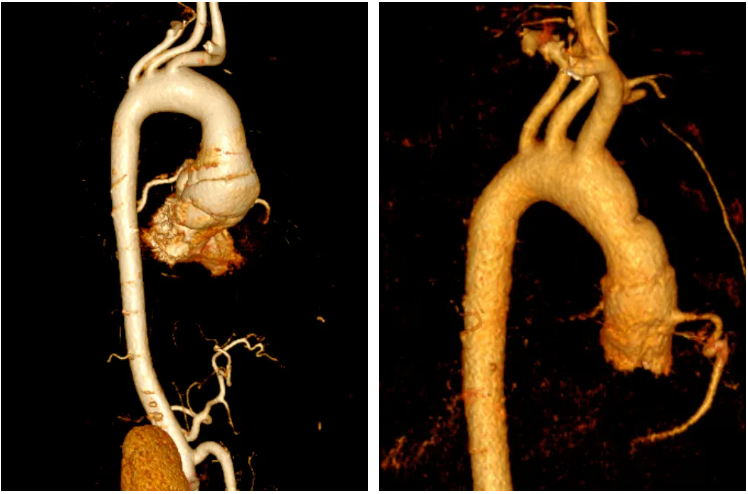 18 岁少年与死神赛跑!绵阳市中心医院创造 A 型主动脉夹层救治新纪录