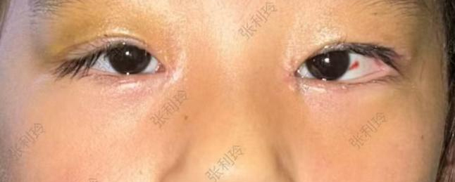 「小眼睛」变大眼萌娃 西安华厦眼科成功为罕见复杂先畸患儿成功矫治