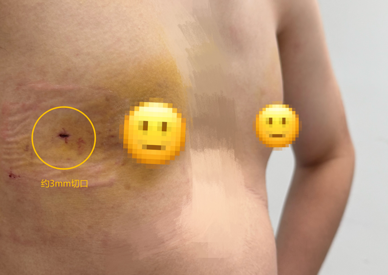 20 岁小伙乳房「疯长」似少女!微创技术助力回归「平坦」胸膛吗?