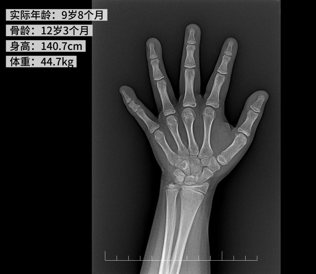 小学四年级女儿突然来月经!一查竟是「性早熟」