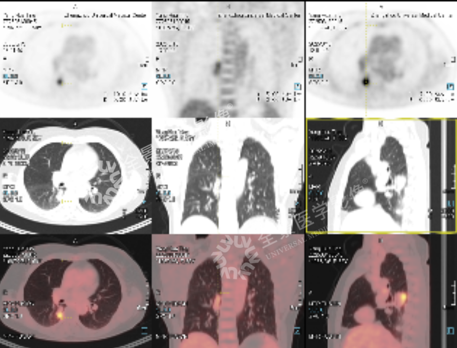 右肺下叶结节的诊断与思考