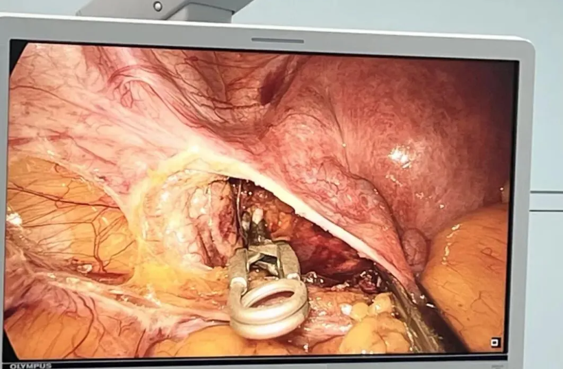 警惕!剖宫产妈妈再孕遭遇「致命陷阱」,微创技术破解危机