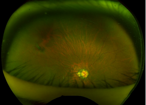 比近视更可怕的事——视网膜裂孔,如何自查?