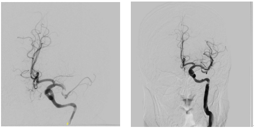 24 岁女子深夜急诊崩溃大哭！年轻人的脑梗危机，比想象来得更早！