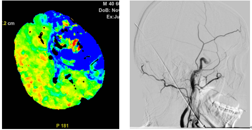 24 岁女子深夜急诊崩溃大哭！年轻人的脑梗危机，比想象来得更早！