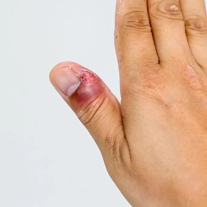 他靠短视频「圈粉」,但留住患者的,是那一手「甲沟炎」绝活