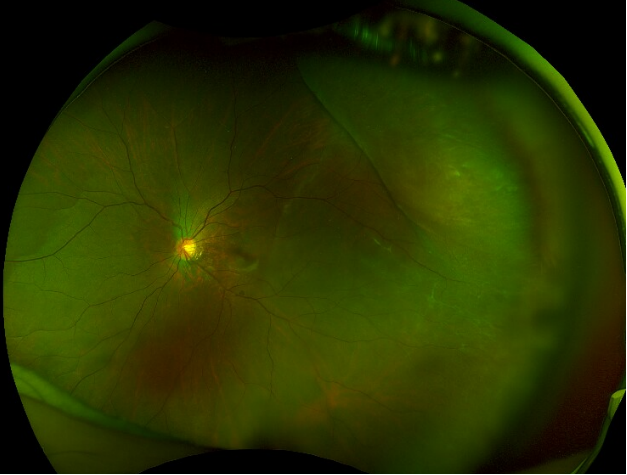 比近视更可怕的事——视网膜裂孔,如何自查?