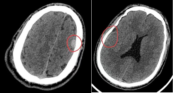 一顿 「豪饮」 命悬一线！小伙喝 1 公斤白酒突发脑出血，贪杯真的会要命