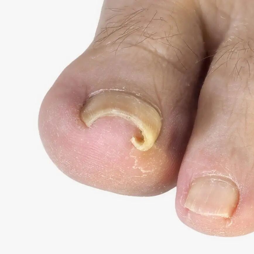 他靠短视频「圈粉」,但留住患者的,是那一手「甲沟炎」绝活