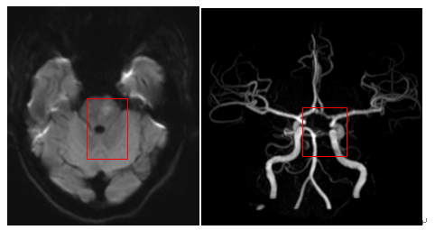 24 岁女子深夜急诊崩溃大哭！年轻人的脑梗危机，比想象来得更早！