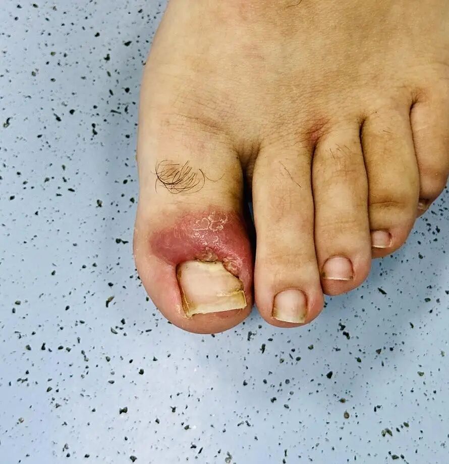 他靠短视频「圈粉」,但留住患者的,是那一手「甲沟炎」绝活