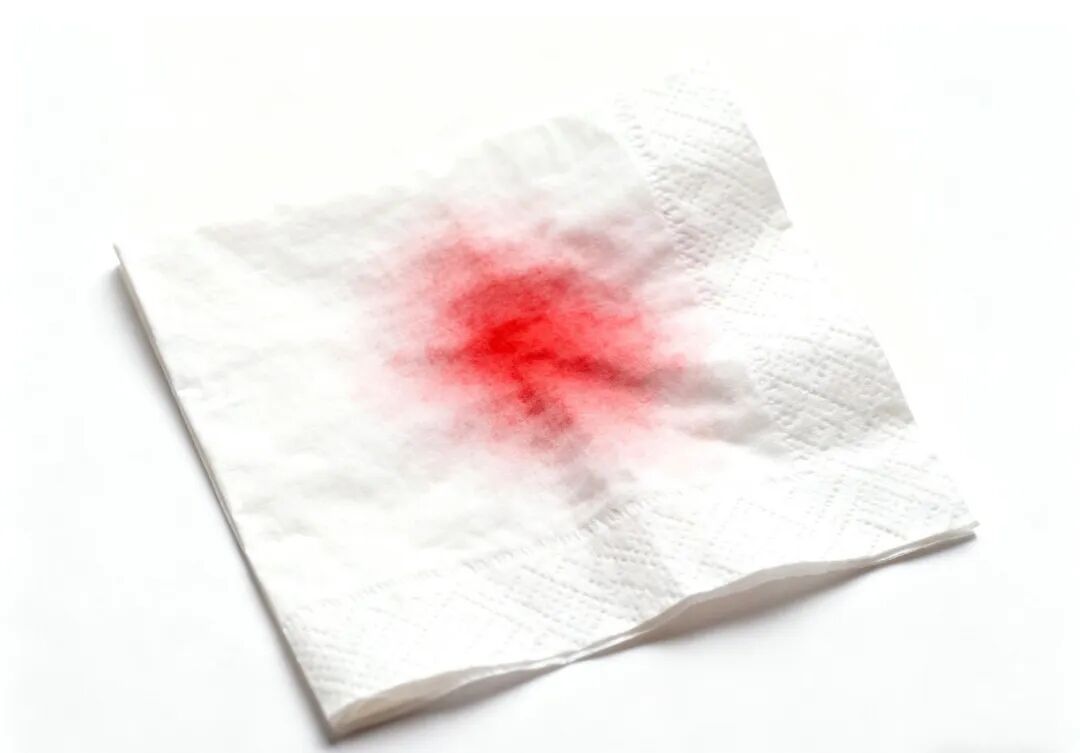 便血剧痛苦不堪言，38 岁白领肛裂与痔疮齐发