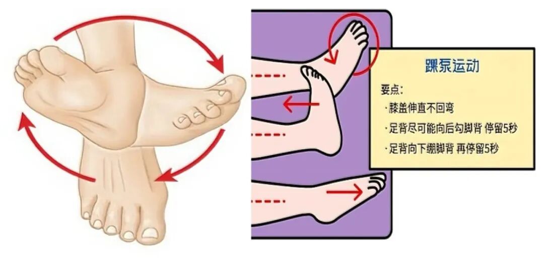 踝泵运动:给腿「泵」走血栓
