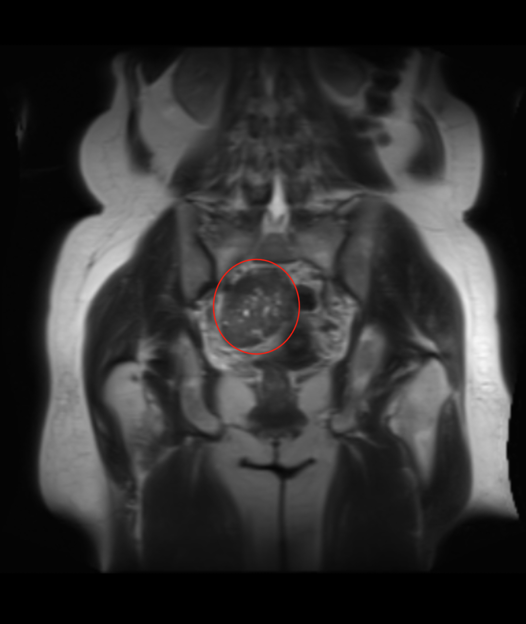 体检惊现「孕 3 月」包块，围绝经期阿姨慌了神​