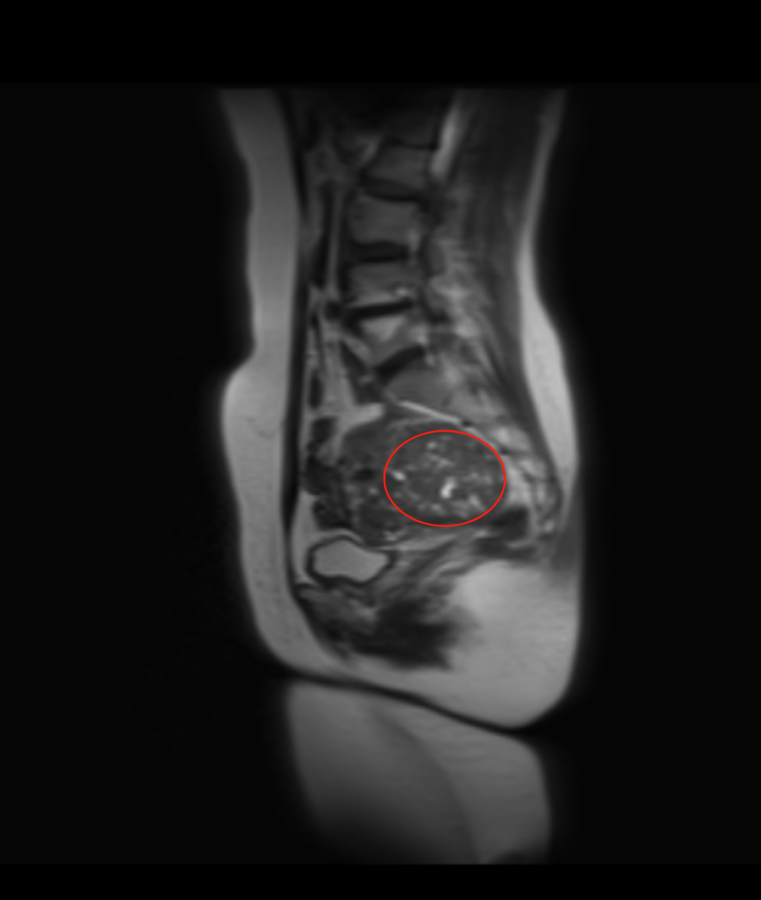 体检惊现「孕 3 月」包块，围绝经期阿姨慌了神​